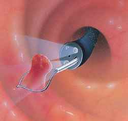 Видалення поліпа цервікального каналу: операція, гістероскопія, лазером