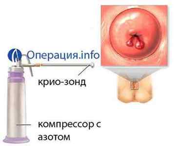 Видалення поліпа матки: ендометрія і шийки - операція гістероскопія, лазером