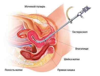 Видалення поліпа матки: ендометрія і шийки - операція гістероскопія, лазером