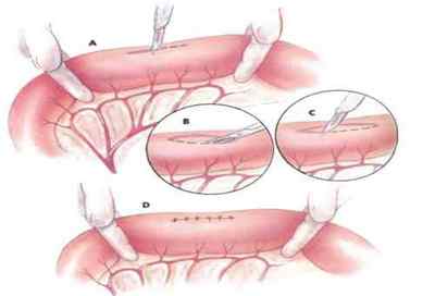 Видалення поліпів кишечника, прямої кишки: операція