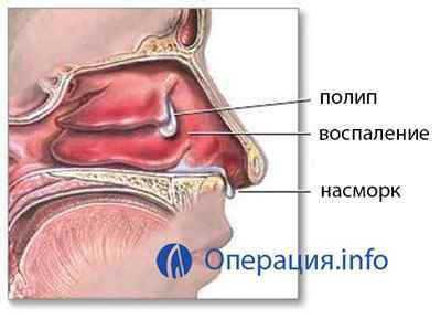 Видалення поліпів у носі (операція полипотомия)