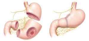 Видалення шлунка: як підготуватися до резекції шлунка, її етапи, реабілітація
