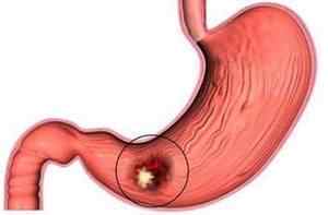 Видалення шлунка: як підготуватися до резекції шлунка, її етапи, реабілітація