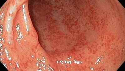 Види гастриту шлунка: симптоми, якими вони проявляються, лікування, як діагностується флегмонозний, аліментарний, фібринозний, поліпозний, коррозівний, гемороїдальних, періульцерозного, дистальний, хімічний, реактивний і інші хвороби