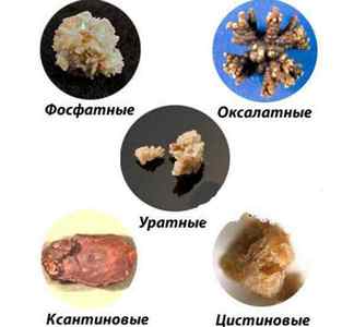 Види каменів в нирках: які бувають, назви і класифікація