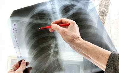 Види і заходи профілактики туберкульозу легенів