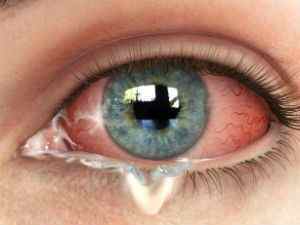 Виділення з очей у дитини або дорослих (білі): причини, лікування нальоту, слизу