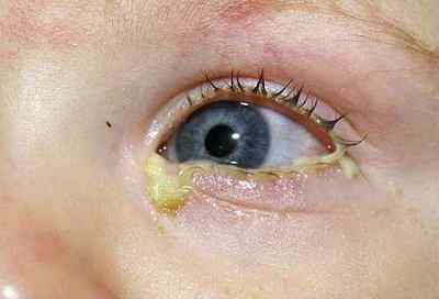 Виділення з очей у дитини або дорослих (білі): причини, лікування нальоту, слизу