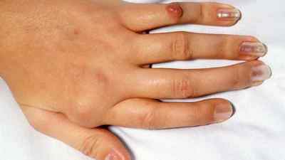 Викривлення пальців на ногах стопи і руках: причини і лікування деформації пальців, як виправити зігнутий палець | Ревматолог