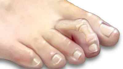 Викривлення пальців на ногах стопи і руках: причини і лікування деформації пальців, як виправити зігнутий палець | Ревматолог