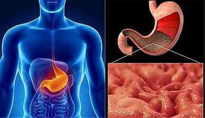 Виразка антрального відділу шлунка: причини, основні симптоми, лікування, дієта