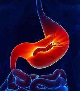 Виразка антрального відділу шлунка: причини, основні симптоми, лікування, дієта