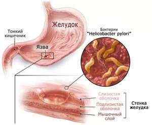 Виразка шлунка: що це, код за МКБ10 симптоми, види, діагностика і лікування