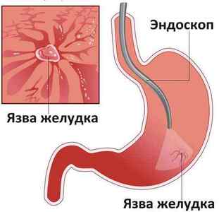Виразка шлунка: що це, код за МКБ10 симптоми, види, діагностика і лікування
