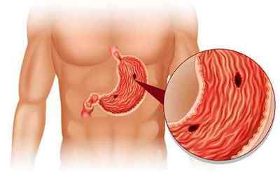 Виразка шлунка: симптоми і лікування (дієта, препарати, хірургія, народне)