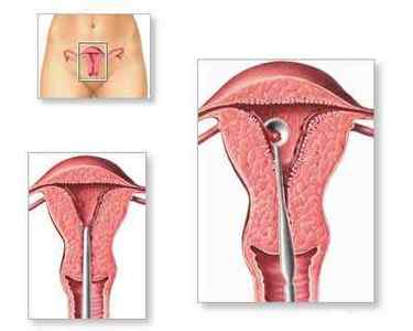 Вишкрібання порожнини матки (ендометрія) і цервікального каналу: показання, проведення