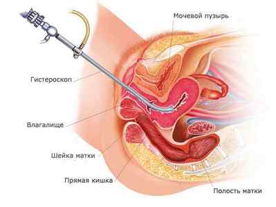 Вишкрібання порожнини матки (ендометрія) і цервікального каналу: показання, проведення