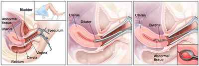 Вишкрібання порожнини матки (ендометрія) і цервікального каналу: показання, проведення
