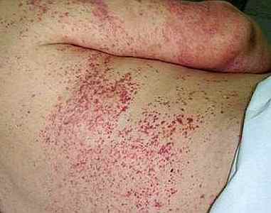 Висип і свербіж шкіри при гепатиті: ознаки і лікування