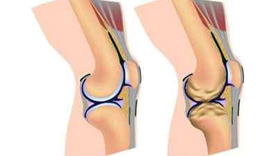 Витончення гиалинового хряща колінного суглоба: товщина в нормі, лікування нерівномірного стоншування, дегенеративні зміни | Ревматолог