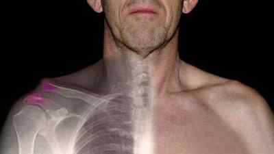 Вивих грудино-ключичного суглоба: розрив звязок ключиці, болить ключиця зліва і плече, припухлість при остеохондрозі | Ревматолог