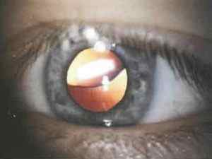 Вивих кришталика ока - причини, симптоми і лікування
