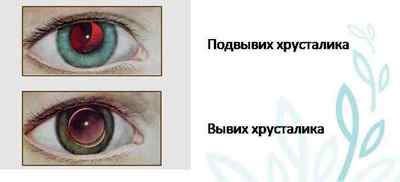 Вивих кришталика ока - причини, симптоми і лікування