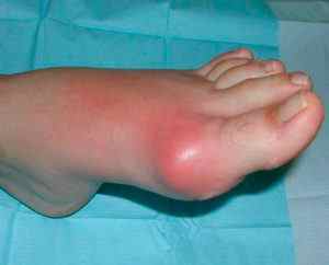 Вивих пальця на нозі - причини, симптоми і лікування