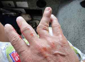 Вивих пальця руки - причини, симптоми і лікування