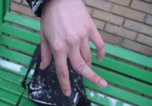 Вивих пальця руки - причини, симптоми і лікування