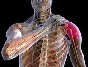 Вивих плечового суглоба - види, причини, симптоми і лікування