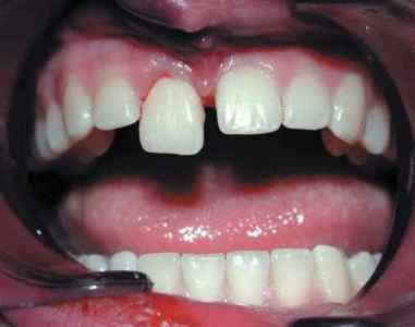 Вивих зуба - причини, симптоми і лікування