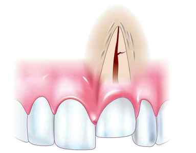 Вивих зуба - причини, симптоми і лікування