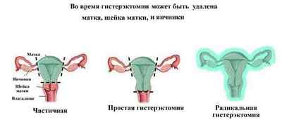 Визначення простої гіперплазії ендометрія без атипії: лікування, відгуки жінок