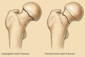 Вколоченний перелом шийки стегна - причини і лікування