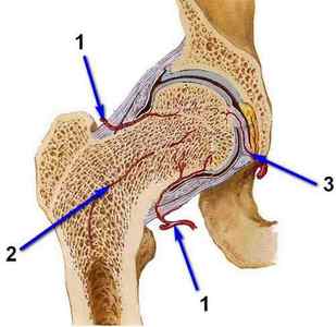 Вколоченний перелом шийки стегна - причини і лікування