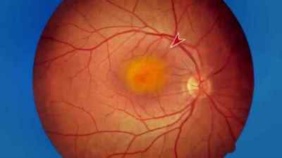 Вікова макулярна дегенерація (ВМД) обох очей: лікування сухої форми, що це таке