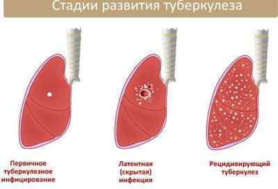 ВІЛ і туберкульоз легень: особенноті течії, прогноз