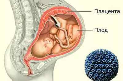Внутрішньоутробна пневмонія у новонароджених: причини і наслідки