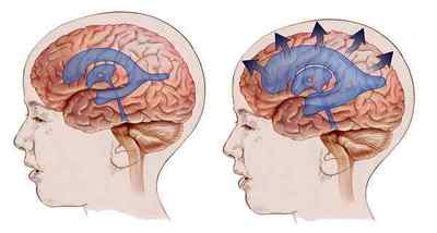 Водянка головного мозку у новонародженого - симптоми, причини, лікування