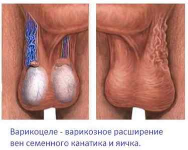 Водянка яєчка у чоловіків: фото, симптоми, лікування і причини