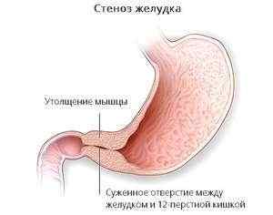 Воротар шлунка: як влаштований, функції, типові хвороби і їх лікування