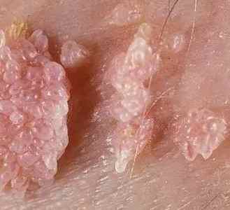 ВПЛ у чоловіків (вірус папіломи людини): лікування, фото, ознаки та симптоми