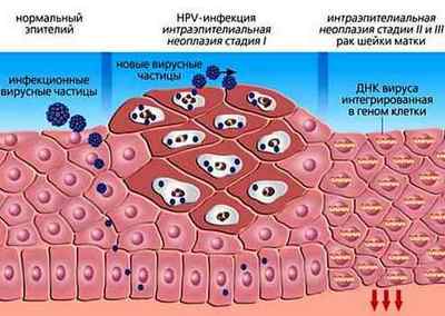 ВПЛ у жінок (вірус папіломи людини): лікування, препарати, симптоми, фото