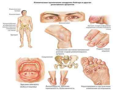 Вплив уреаплазми на суглоби: причини, симптоми і діагностика