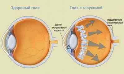 Вроджена глаукома у дітей: фото, причини, симптоми, класифікація