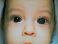 Вроджена катаракта у дітей і дорослих: фото, причини, симптоми і лікування