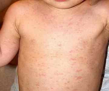 Вірус герпесу 6 типу у дітей - зясовуємо симптоми, лікування захворювання