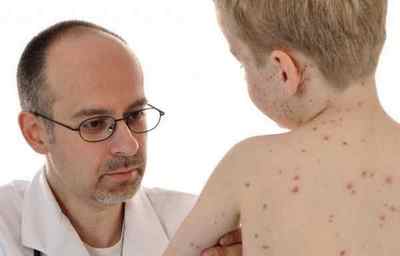 Вірус герпесу 6 типу у дітей - зясовуємо симптоми, лікування захворювання