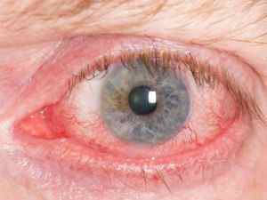 Вірусне захворювання очей у людини: поширені хвороби, симптоми